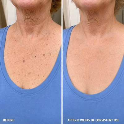 SK Renewal 40 — Advanced Keratolytic Cream For Rough, Raised Seborrheic Keratoses