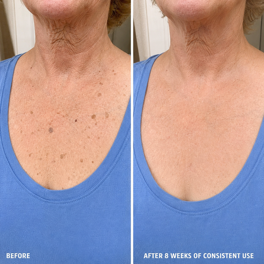SK Renewal 40 — Advanced Keratolytic Cream For Rough, Raised Seborrheic Keratoses