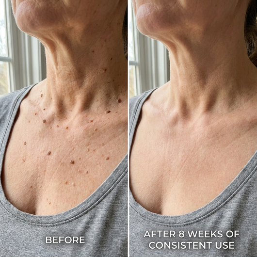 SK Renewal 40 — Advanced Keratolytic Cream For Rough, Raised Seborrheic Keratoses