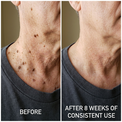 SK Renewal 40 — Advanced Keratolytic Cream For Rough, Raised Seborrheic Keratoses